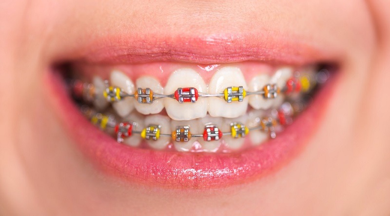 การเลือกสียางจัดฟันให้ฟันดูขาว & เข้ากับสีผิว