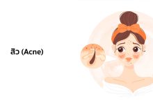 สิว (Acne) - อาการ สาเหตุ และการรักษา
