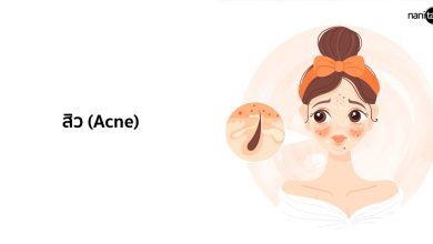 สิว (Acne) - อาการ สาเหตุ และการรักษา