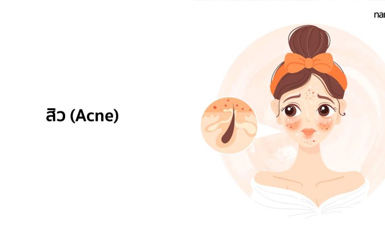 สิว (Acne) - อาการ สาเหตุ และการรักษา