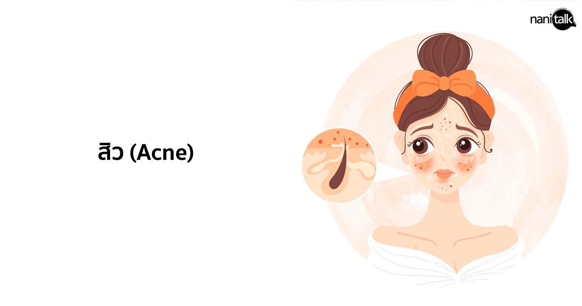 สิว (Acne) - อาการ สาเหตุ และการรักษา
